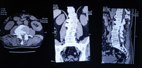 CT image of the spine of a patient with scoliosis and protrusion of the intervertebral disc.