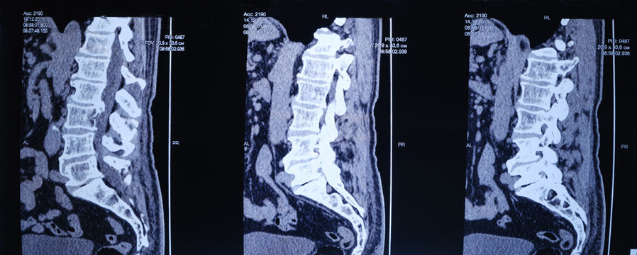 CT image of the spine of a patient with scoliosis and protrusion of the intervertebral disc.