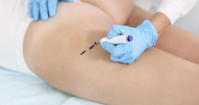 Doctor draws marks on buttocks with marker for body shaping slow motion 4k movie