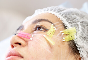 Thread lifting is a cosmetological procedure for face rejuvenation. The beautician implants...