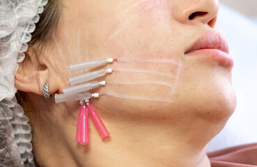 Thread lifting is a cosmetological procedure for face rejuvenation. The beautician implants...