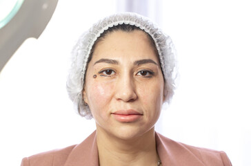 Thread lifting is a cosmetological procedure for face rejuvenation. Before and after, half of the...