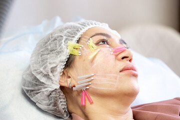 Thread lifting is a cosmetological procedure for face rejuvenation. The beautician implants cosmetic threads under the skin to relieve facial ptosis.