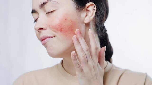 Close-up portrait of a young beautiful woman touching the redness on her cheek with her fingers. White background. The concept of rosacea and couperose.
