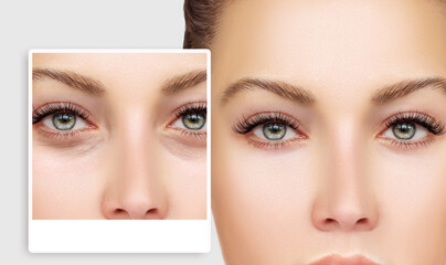 Lower eyelid blepharoplasty.Upper blepharoplasty.Before and after cosmetic procedures