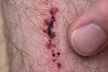 Bruised skin macro close up shot of hairy Caucasian male leg. Index finger pointing at scars