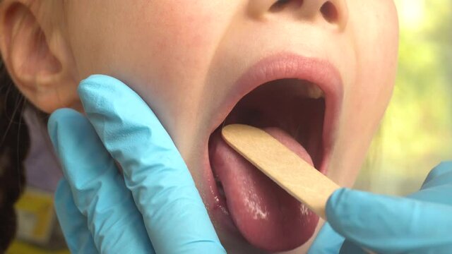 Close-up of a doctor examining a child's mouth and throat using a tongue depressor.ENT medicine.