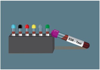 Blood sample for erythrocyte sedimentation rate (ESR) test. Medical test tube in laboratory background.