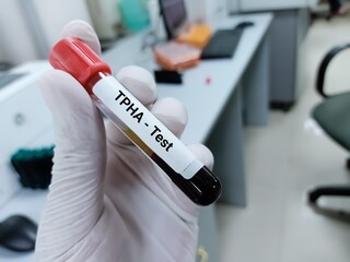 Biochemist or doctor holds blood sample for Treponema pallidum haemagglutination (TPHA) test,...