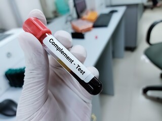Blood sample for complement test, diagnosis of autoimmune disorders. Medical test tube in laboratory background.