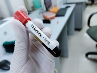 Blood sample for Thiamine test, Vitamin B1. Medical test tube in laboratory background.