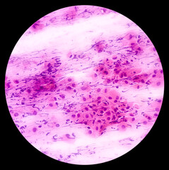 Vault smear: Reactive cellular changes with inflammation, photo under microscope showing...