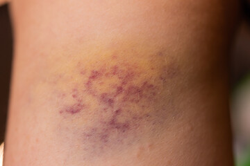 Closeup Bruise on wounded woman's leg skin.