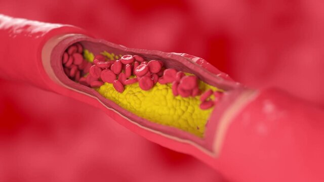 red blood cells flow through the vessel affected by cholesterol plaque. High quality FullHD footage