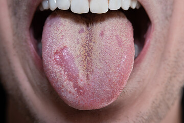 Caucasian male tongue with yeast infection candida. Macro close up shot, unrecognizable