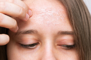 Close-up of a female forehead with peeling skin isolated on a white background. Allergies, eczema,...