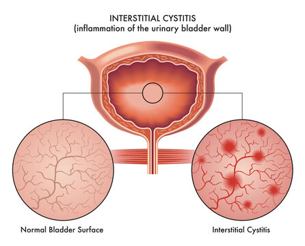 Medical illustration of the symptoms of interstitial cystitis.