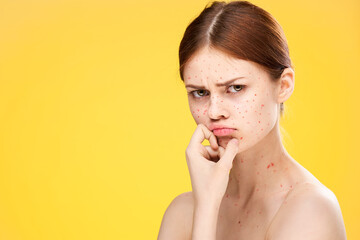 Naklejka premium woman with bare shoulders red dots on her face health problems dermatology
