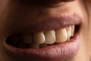 Close up photo of a woman with the cracked teeth. Teeth care concept. Selective focus.