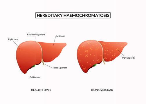 Hereditary Hemochromatosis Disease.