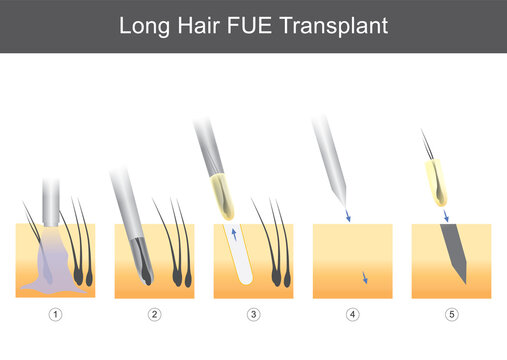 Long Hair FUE Transplant. Illustration for medical showing technical steps of hair transplantation..