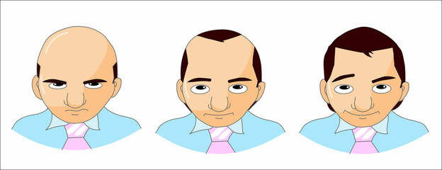 Hair loss, hair transplant. Expressions, Sad, angry, happy middle age cardboard male character. drawing from baldness to dense hairstyle. Formal, in executive attire. Illustration vector