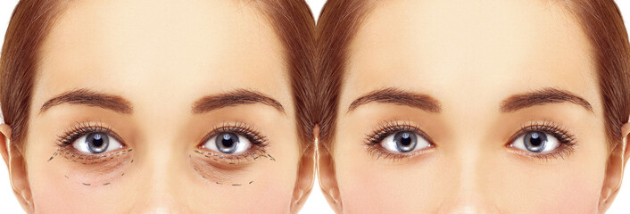 Lower eyelid blepharoplasty.Upper  blepharoplasty.Before and after cosmetic procedures - obrazy, fototapety, plakaty