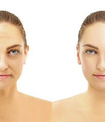 Plastic Surgery Results,Nasolabial folds,Neck ,Under eye circles,neck lines.