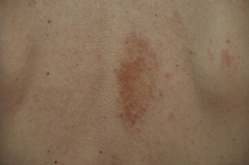 Fototapeta premium Eczema pimples on a back