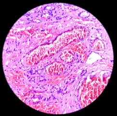 Microphotograph of Nodular goitre with adenomatous change, thyroid gland tissue