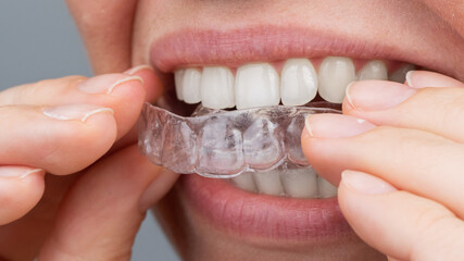 Caucasian woman putting on aligners. Orthodontic teeth straightening device.