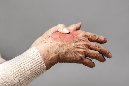 A senior woman is doing a brush massage, experiencing pain. Gray background, hands close-up. The concept of rheumatism and arthritis