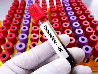 Laboratory sample of blood for doping drugs LSD, test. Doping is the used of banned athletic...