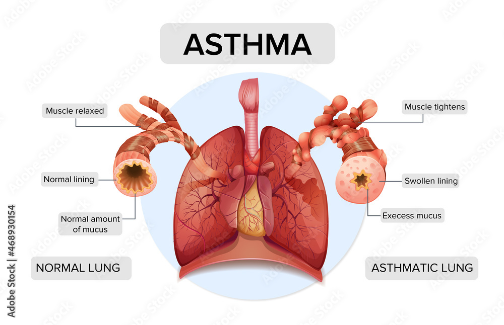 Wall mural Asthma. Lung structure