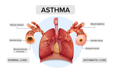 Asthma. Lung structure - obrazy, fototapety, plakaty