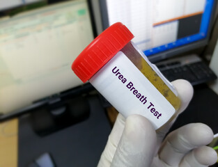 Technician hold container with stool sample for Urea breath test. Helicobacter pylori. diagnosis for peptic ulcer.