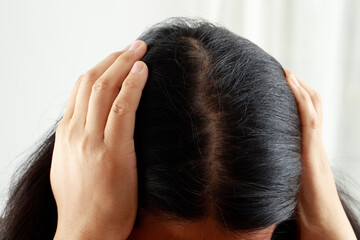 Naklejka premium A woman has problems with hair and scalp,she has dandruff from allergic reactions to shampoos. and hair conditioner
