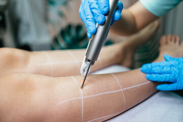 Young woman receiving laser epilation or permanent body hair removal treatment. Modern technology...