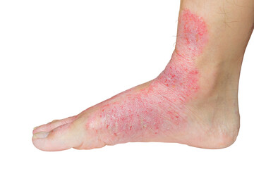 Isolated foot. Rash, Wound, and Dry skin on human foot.