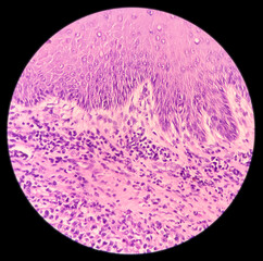 Microscopic image of malignant melanoma in pigmented ulcer. show malignant neoplasm, atypical...