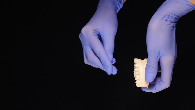 Dental concept on black background. Model of teeth and dental bridging being held by hands in blue gloves. Vertical footage. Removable partial denture, mandibular prosthesis. Medically prosthodontics