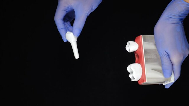 Dental human teeth concept shot on black background. Tooth extraction. Losing molar tooth shown on teeth model held by female hands in blue gloves. Vertical footage. 4 k video