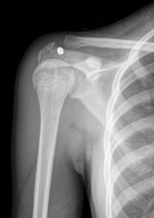 x ray of corpus alienum bullet on shoulder after gun shot