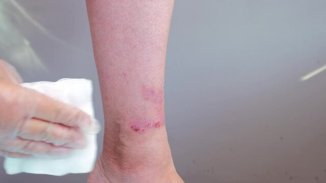 female doctor assistant examines and treats leg woman with scratches, scars, eczema, skin flayed on lower leg, wounds are bleeding, concept of medical care, scratching sores, self-harm