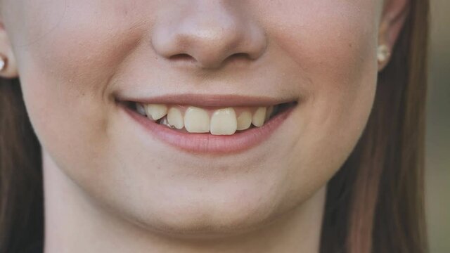 A teenage girl demonstrates her crooked teeth.