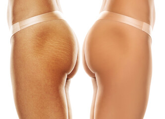 comparison before and after Woman buttocks with stretch marks removal treatment