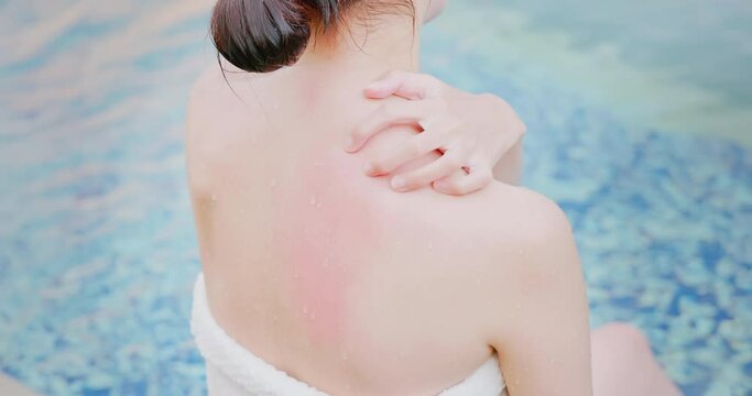 woman sunburn in swimming pool