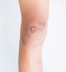 Scar and blemishes Dark spots on the skin of the person on the leg