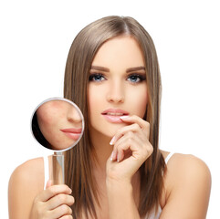 Post-Acne Marks ,Treating Acne Scars.Acne Scar Removal