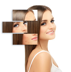 Post-Acne Marks ,Treating Acne Scars.Acne Scar Removal